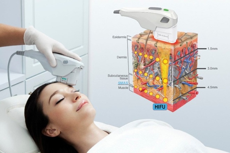 Cách phòng ngừa lỗi đếm shot và bảo dưỡng máy HIFU hiệu quả