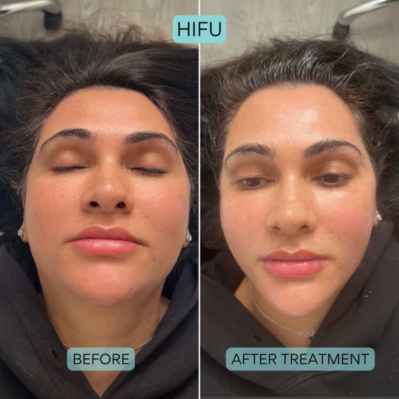 Lợi ích và hiệu quả của HIFU Lợi ích và hiệu quả của HIFU