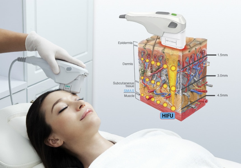 Giới thiệu về HIFU Giới thiệu về HIFU