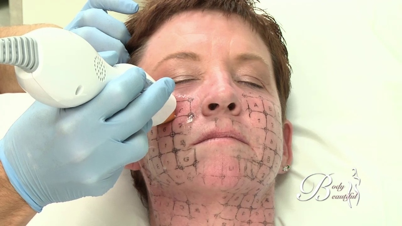 Ưu Điểm Khi Chọn Máy Spa Asia Để Sửa Máy Thermage